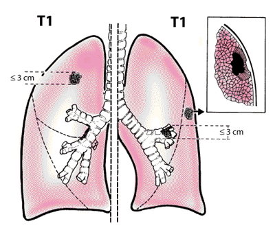 T1