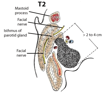 T2