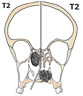 T2