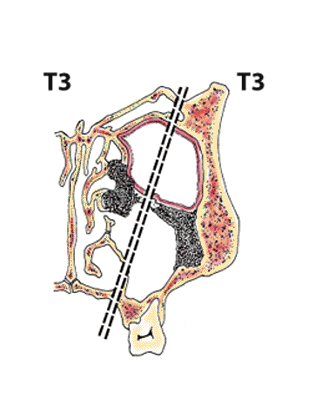 T3