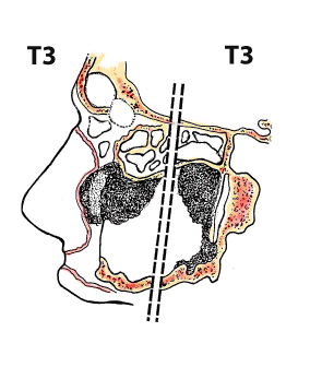 T3