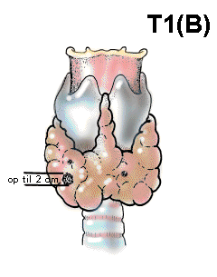 T1b