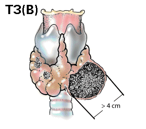 T3b